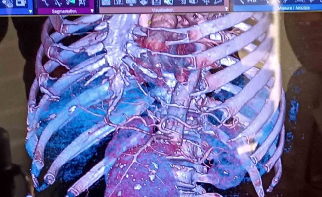 Aort damarı kalp büyüklüğünde şişen hastayı aynı anda 2 ameliyatla hayatta tuttular