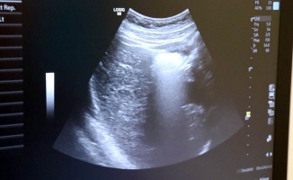 4 boyutlu ultrason ile bebeğin hastalıkları doğmadan anlaşılıp tedavi edilebiliyor
